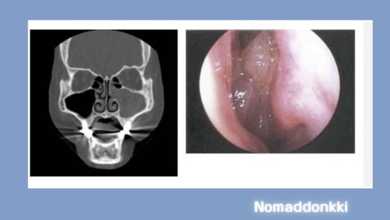 부비동염 증상 보충 이미지